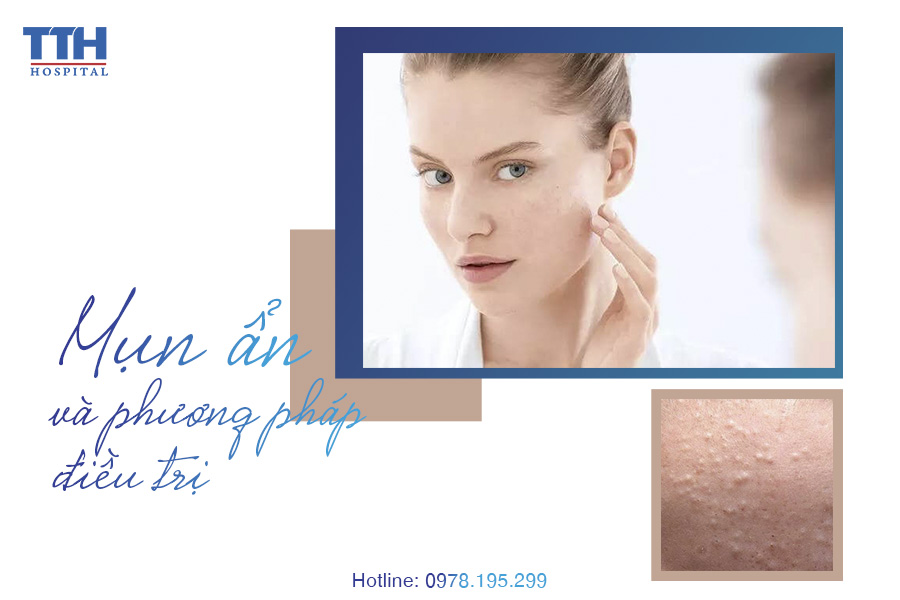 MỤN ẨN LÀ GÌ? ĐIỀU TRỊ MỤN ẨN NHƯ THẾ NÀO?